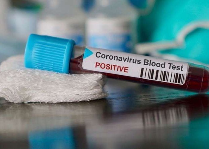 Coronavirus en Algérie (nouveau bilan) : 127 cas, 7 décès, 199 guéris et 34 patients en soins intensifs 